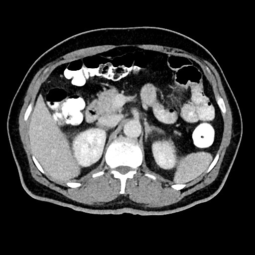 Acute appendicitis (Radiopaedia 77016-88960 Axial C+ portal venous phase 49).jpg