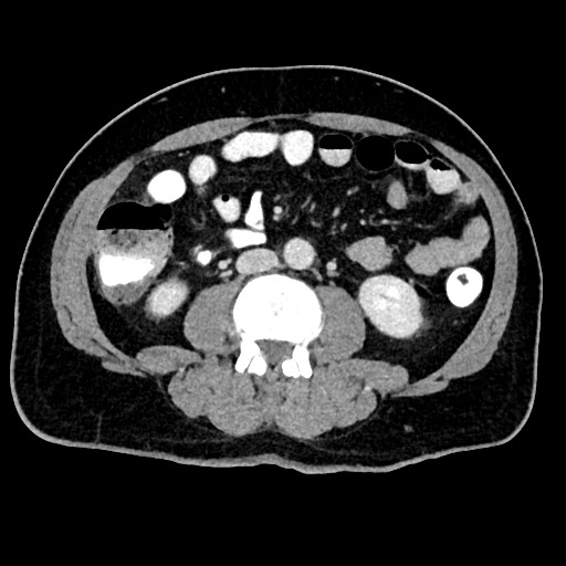 Acute appendicitis (Radiopaedia 77016-88960 Axial C+ portal venous phase 77).jpg