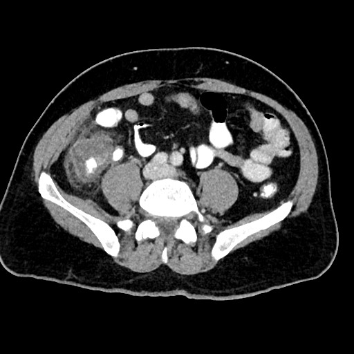 File:Acute appendicitis (Radiopaedia 77016-88960 Axial C+ portal venous phase 94).jpg
