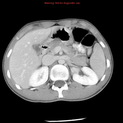 Acute appendicitis (Radiopaedia 8195-9045 Axial C+ portal venous phase 23).jpg