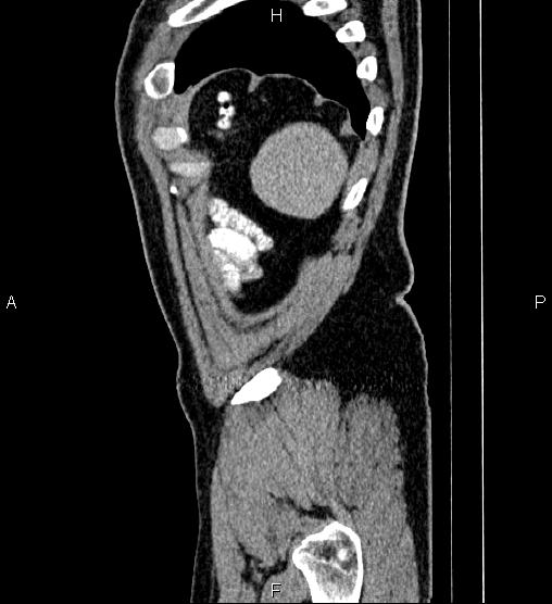 Acute appendicitis (Radiopaedia 84780-100240 Sagittal C+ portal venous phase 100).jpg