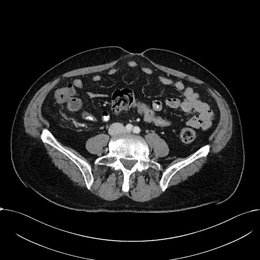 File:Acute appendicitis - large appendicoliths (Radiopaedia 61805-69820 Axial C+ portal venous phase 80).jpg