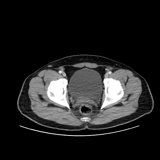 Acute appendicitis and COVID 19 pneumonia (Radiopaedia 76604-88380 Axial C+ portal venous phase 79).jpg