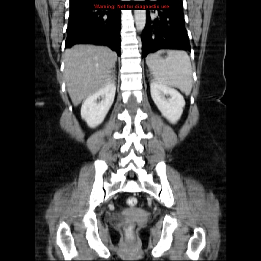 File:Acute appendicitis complicated by ovarian vein thrombophlebitis (Radiopaedia 16172-15851 Coronal C+ portal venous phase 59).jpg
