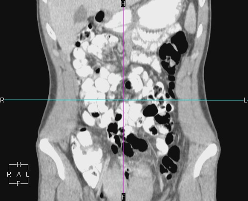File:Acute appendicitis with CT arrowhead sign (Radiopaedia 21474-21411 Coronal C+ portal venous phase 2).JPG
