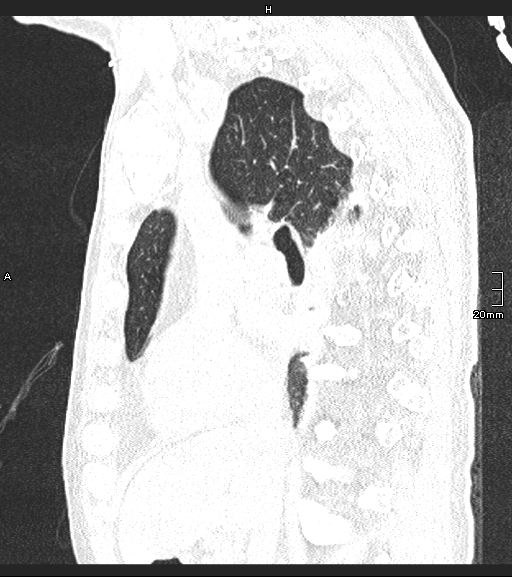 File:Acute aspiration pneumonitis (Radiopaedia 55642-62166 Sagittal lung window 91).jpg