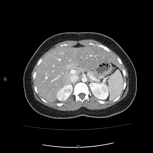 Acute bilateral pyelonephritis (Radiopaedia 37146-38881 Axial C+ portal venous phase 28).jpg