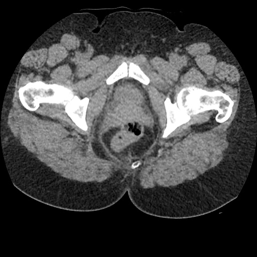 File:Acute cholecystitis and ureteric colic (Radiopaedia 42330-45444 Axial prone 111).jpg