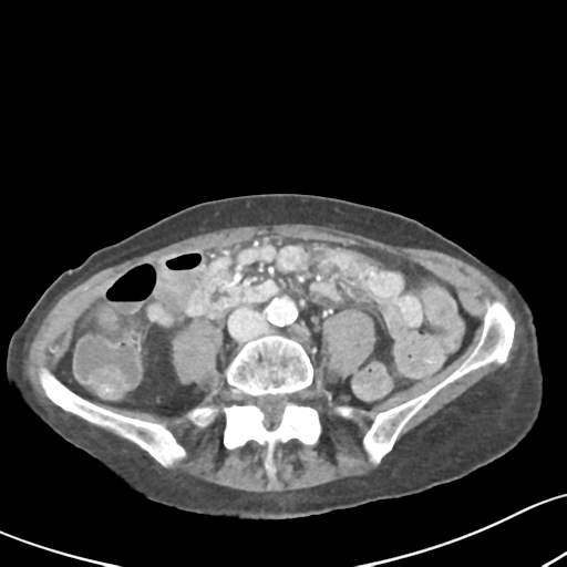 Acute cholecystitis with contained perforation (Radiopaedia 47328-51907 Axial C+ portal venous phase 44).png