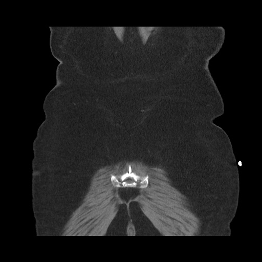 Acute cholecystitis with tensile fundus sign (Radiopaedia 71394-81723 Coronal non-contrast 112).jpg