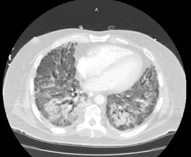 Acute cor pulmonale (ultrasound) (Radiopaedia 83508-98818 Axial lung window 58).jpg