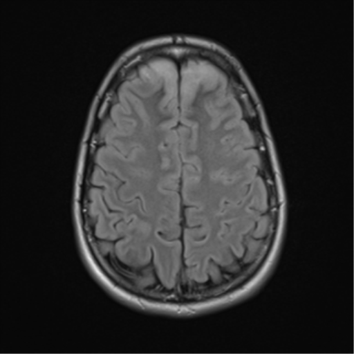 File:Acute disseminated encephalomyelitis (ADEM) (Radiopaedia 65319-74349 Axial FLAIR 24).png