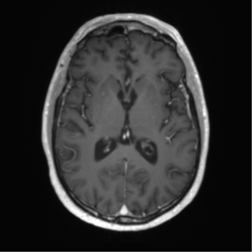 Acute disseminated encephalomyelitis (ADEM) (Radiopaedia 65319-74350 Axial T1 C+ 32).png