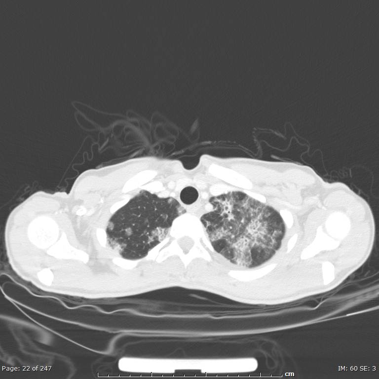 Acute eosinophilic pneumonia (Radiopaedia 48211-53073 Axial lung window 8).jpg