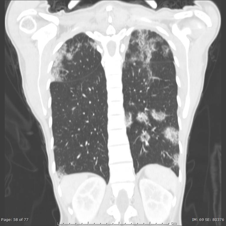 Acute eosinophilic pneumonia (Radiopaedia 48211-53073 Coronal lung window 39).jpg
