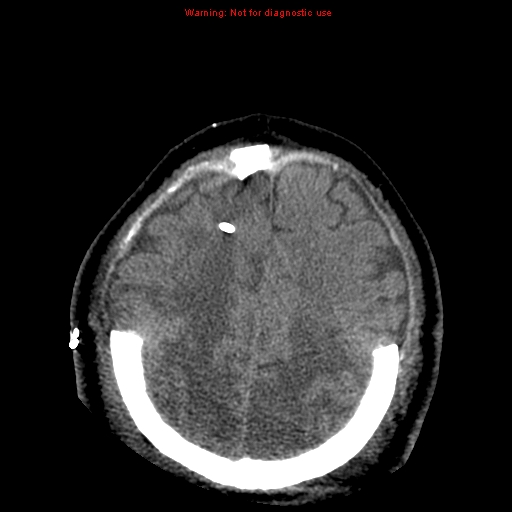 Acute hemorrhagic leukoencephalitis (Radiopaedia 14076-43697 Axial non-contrast 39).jpg