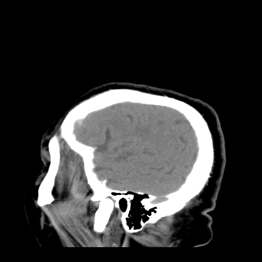 File:Acute hemorrhagic stroke (Radiopaedia 17507-17223 Sagittal non-contrast 39).jpg