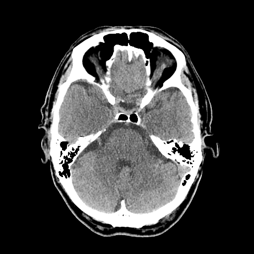 File:Acute hippocampal infarction (Radiopaedia 10610-11071 non-contrast 1).jpg