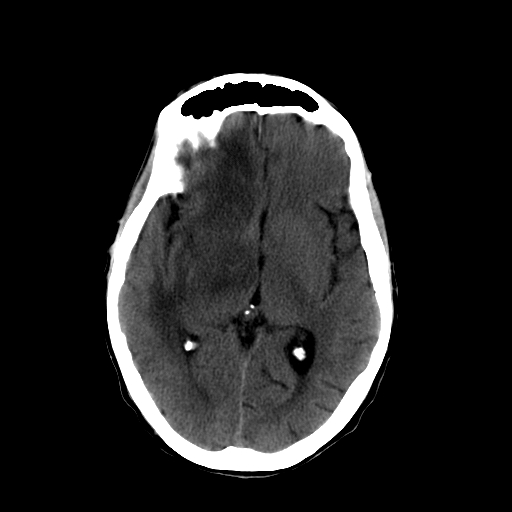 File:Acute necrotizing toxoplasma encephalitis (Radiopaedia 10683-11150 B 18).jpg