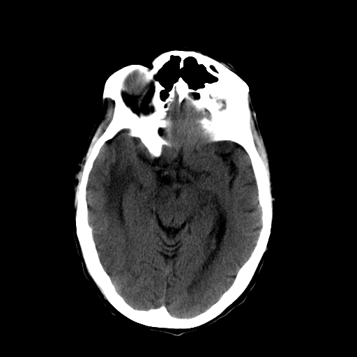 File:Acute necrotizing toxoplasma encephalitis (Radiopaedia 10683-11150 B 20).jpg