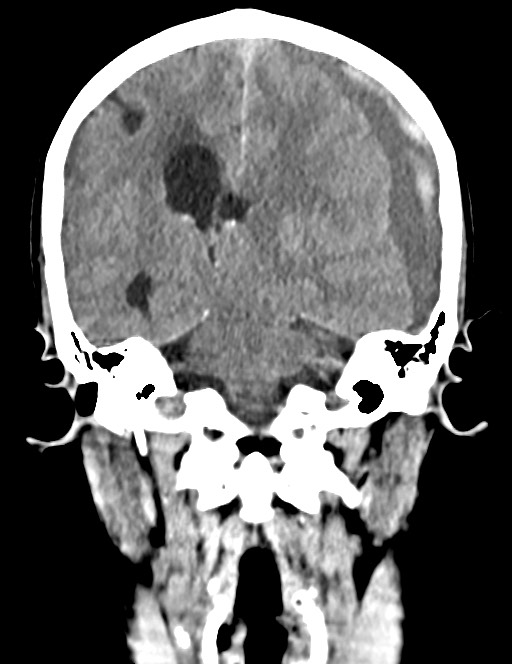 Acute on chronic subdural hematoma (Radiopaedia 74814-85823 Coronal non-contrast 39).jpg