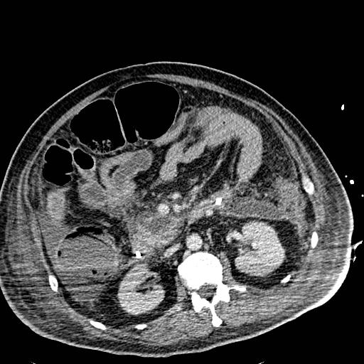 Acute pancreatic necrosis (Radiopaedia 13560-18501 Axial C+ portal venous phase 62).jpg