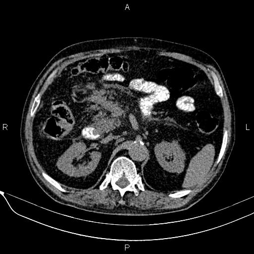 Acute pancreatitis (Radiopaedia 85146-100701 Axial non-contrast 46).jpg