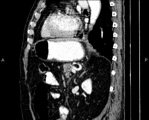 Acute pancreatitis (Radiopaedia 85146-100701 Sagittal C+ portal venous phase 62).jpg