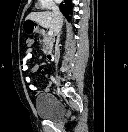 Acute pancreatitis (Radiopaedia 85390-101010 Sagittal C+ portal venous phase 43).jpg