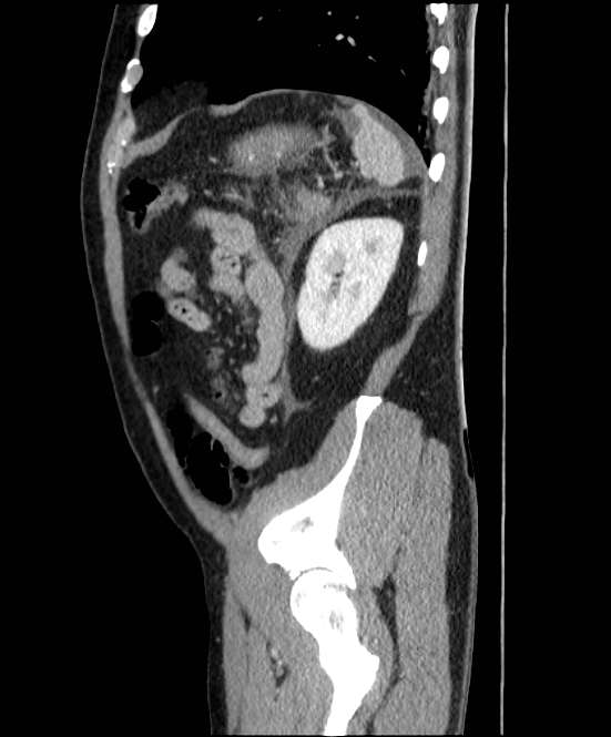 Acute pancreatitis - Balthazar E (Radiopaedia 23080-23110 Sagittal C+ portal venous phase 80).jpg