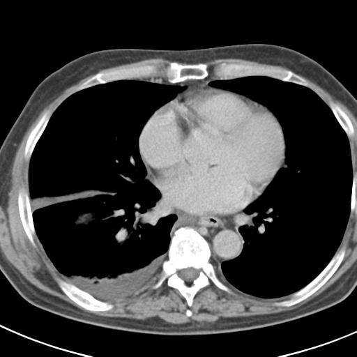 Acute pancreatitis and walled-off necrosis (Radiopaedia 29888-30403 Axial C+ delayed 3).jpg