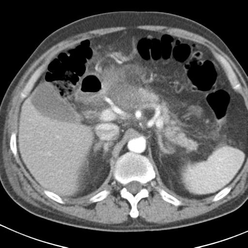 File:Acute pancreatitis and walled-off necrosis (Radiopaedia 29888-30403 Axial C+ portal venous phase 12).jpg