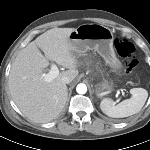 File:Acute pancreatitis and walled-off necrosis (Radiopaedia 29888-30403 Axial C+ portal venous phase 7).jpg