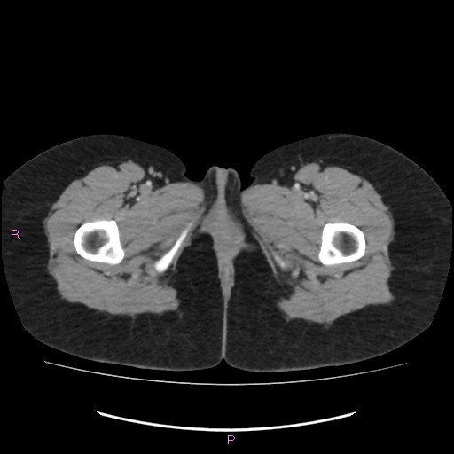File:Acute pancreatitis secondary to stone at minor papilla and pancreatic divisum (Radiopaedia 76570-88333 Axial C+ portal venous phase 90).jpg