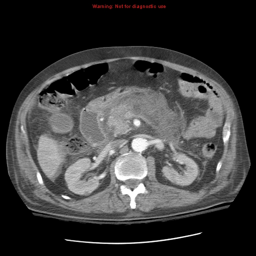 Acute pancreatitis with incidental pancreatic lipoma (Radiopaedia 10190-10730 Axial C+ arterial phase 43).jpg