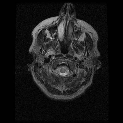 File:Acute pontine infarct from vertebral artery dissection (Radiopaedia 34111-35370 Axial T2 1).png