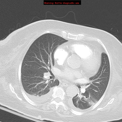 File:Acute pulmonary embolism (Radiopaedia 13286-13289 B 22).jpg