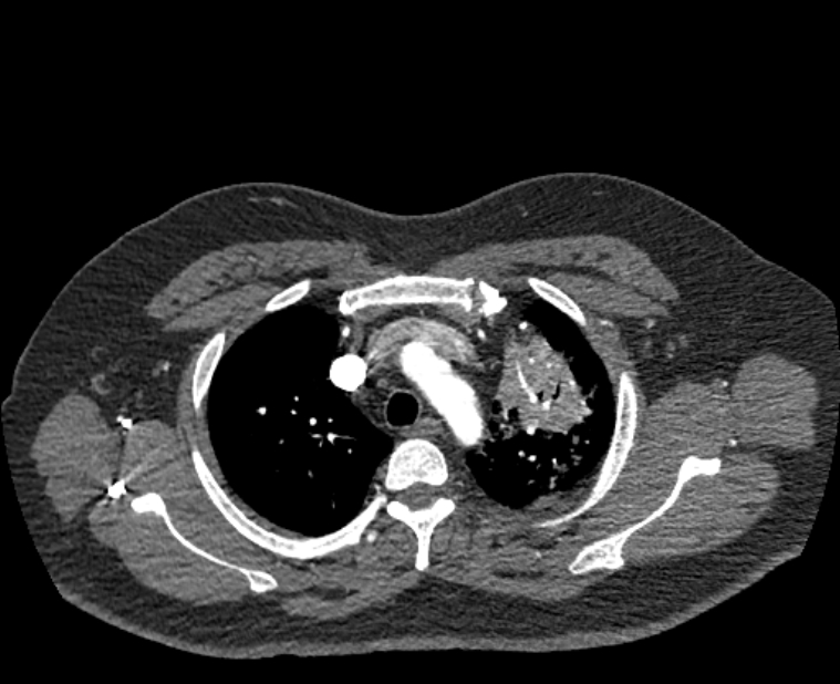 Acute pulmonary embolism with pulmonary infarcts (Radiopaedia 77688-89908 Axial C+ CTPA 11).jpg