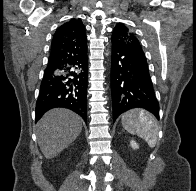 Acute pulmonary embolism with pulmonary infarcts (Radiopaedia 77688-89908 Coronal C+ CTPA 76).jpg