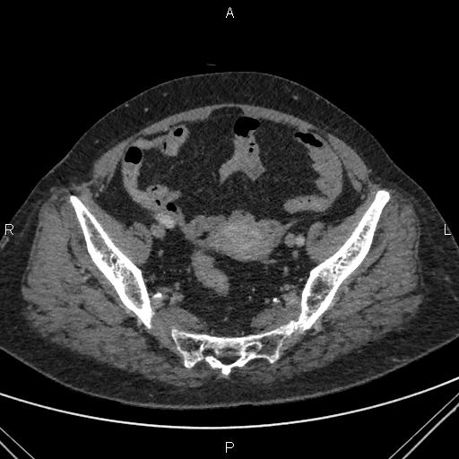 File:Acute renal artery occlusion (Radiopaedia 86586-102682 Axial C+ portal venous phase 81).jpg