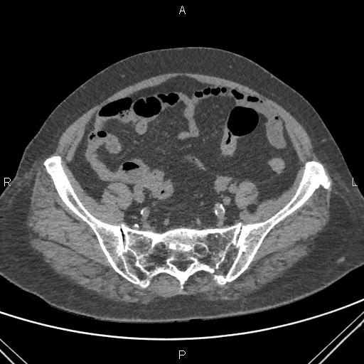 Acute renal artery occlusion (Radiopaedia 86586-102682 Axial non-contrast 70).jpg
