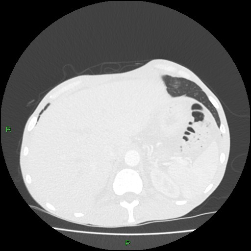 Acute right lung abscess (Radiopaedia 34806-36258 Axial lung window 177).jpg