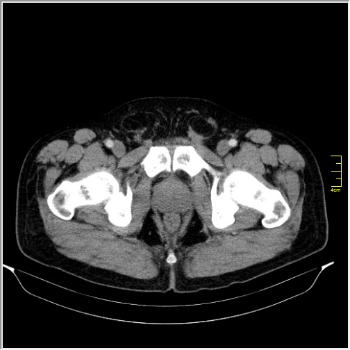 Acute right sided diverticulitis (Radiopaedia 65249-74268 Axial C+ portal venous phase 80).JPG