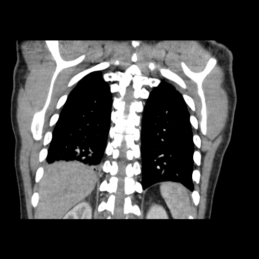 Acute segmental pulmonary emboli and pulmonary infarction (Radiopaedia 62264-70444 Coronal C+ CTPA 45).jpg