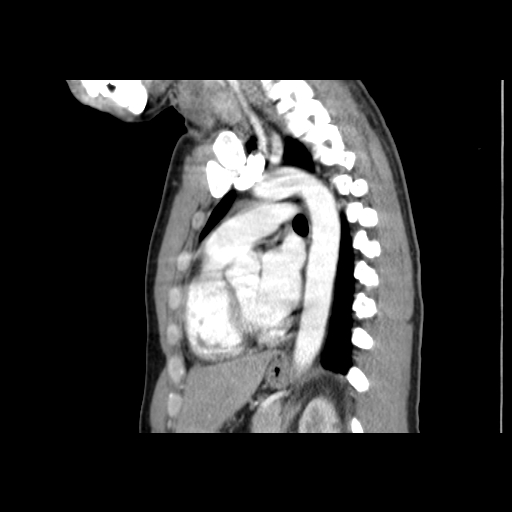 Acute segmental pulmonary emboli and pulmonary infarction (Radiopaedia 62264-70444 Sagittal C+ CTPA 40).jpg