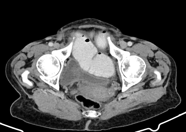Acute small bowel (ileal) volvulus (Radiopaedia 71740-82139 Axial C+ portal venous phase 184).jpg
