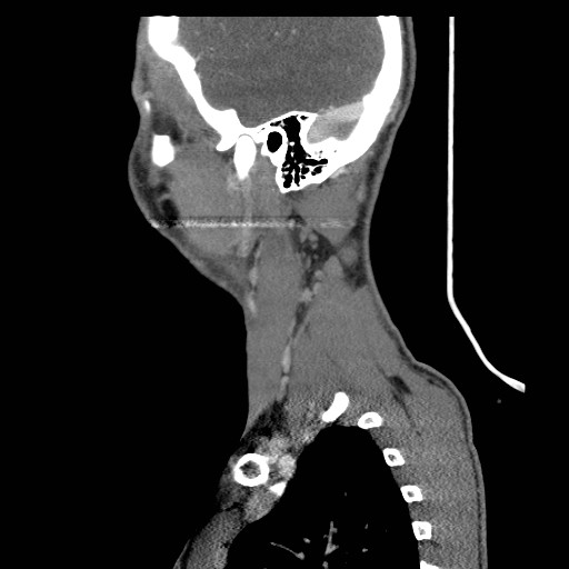 File:Acute submandibular sialadenitis secondary to ductal stone (Radiopaedia 27999-28267 Sagittal C+ delayed 4).jpg
