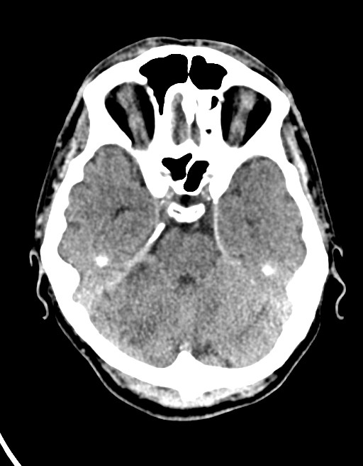 Acute superior cerebellar artery territory infarct (Radiopaedia 84104-99359 Axial non-contrast 47).jpg