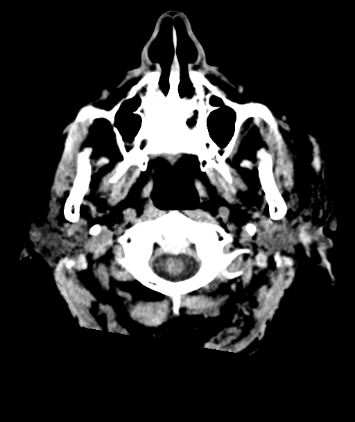 Acute traumatic subdural hematoma (Radiopaedia 82921-97257 Axial non-contrast 62).jpg