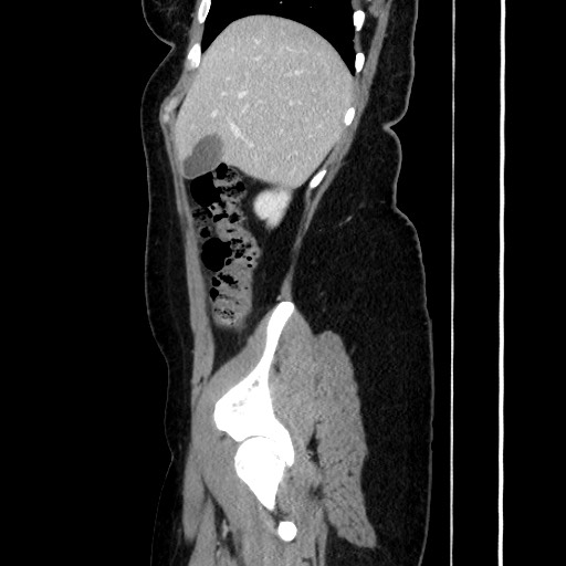 File:Acute uncomplicated appendicitis (Radiopaedia 73704-84499 Sagittal C+ portal venous phase 66).jpg